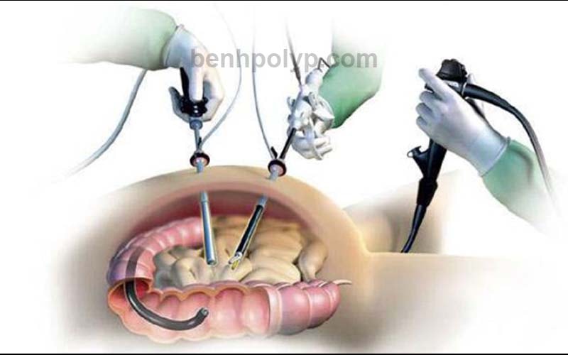 Phẫu thuật nội soi cắt polyp đại tràng